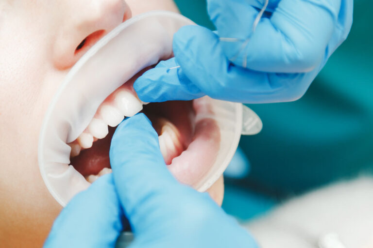 Alimentos nocivos para los dientes