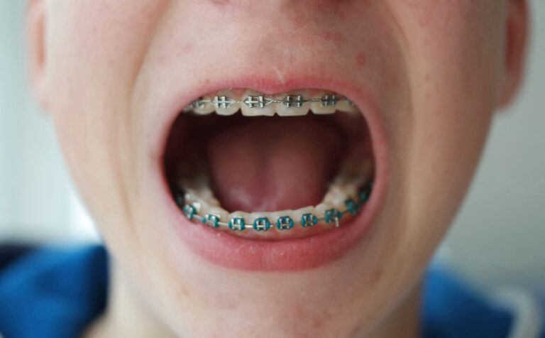 cuidado de los brackets