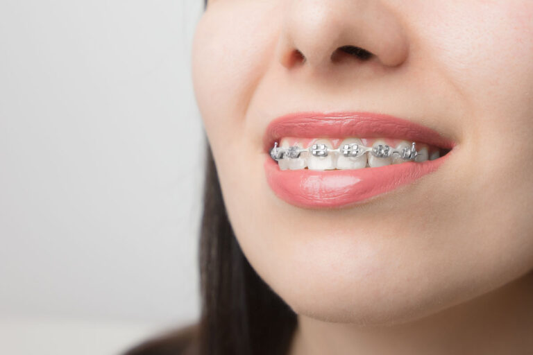 La evolución de los brackets: de metálicos a estéticos